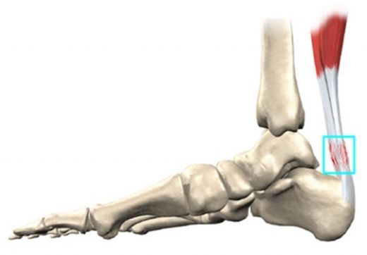 Ayağın Arkasında Kemik Çıkması Belirtileri ve Tedavisi