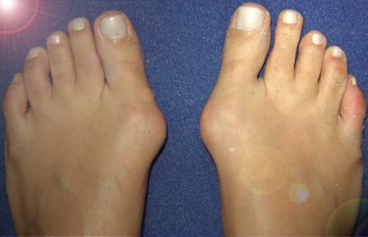 Ayak Baş Parmağı Kemik Çıkıntısı