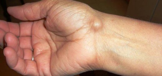 Ayak Üstünde Kemik Çıkıntısı Belirtileri ve Tedavisi