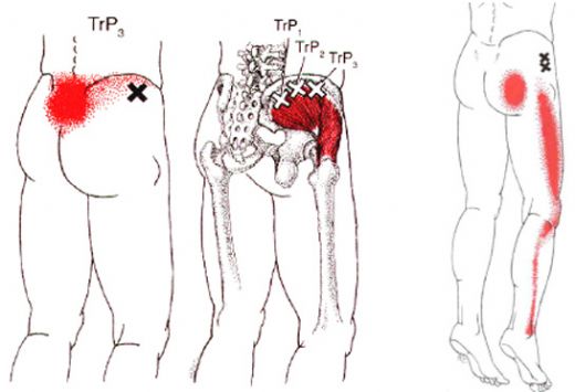 Bacak Kemik Ağrısı Belirtileri ve Tedavisi