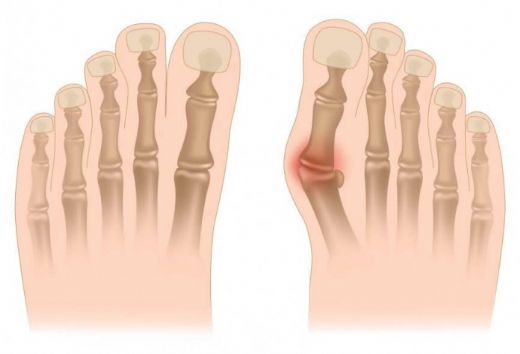 Başparmak Kemik Çıkıntısı Belirtileri ve Tedavisi