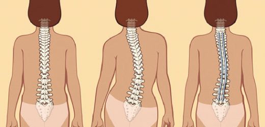 Bel Kemiği Eğriliği Belirtileri ve Tedavisi