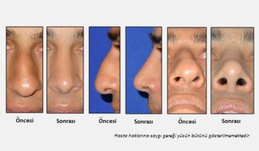 Burun İçi Kemik Eğriliği Ameliyatı Riskleri ve Sonrası
