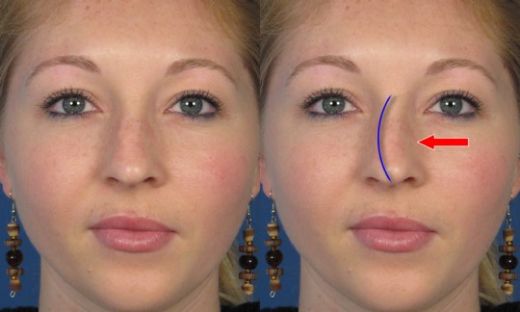 Burun Kemiği Eğriliği Belirtileri ve Tedavisi