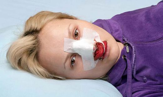 Burun Kemiği Eğriliği Ameliyatı Riskleri ve Sonrası