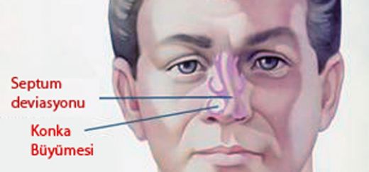 Burunda Kemik Büyümesi Belirtileri ve Tedavisi