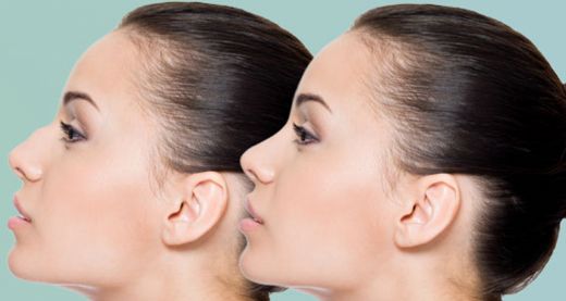 Burunda Kemik Büyümesi Ameliyatı Riskleri ve Sonrası