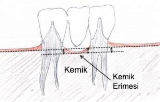 Diş Kemik Erimesi Belirtileri ve Tedavisi