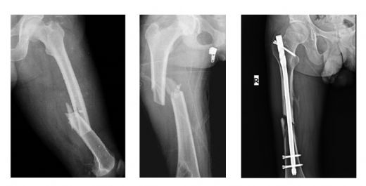 Femur Kemiği Kırığı Belirtileri ve Tedavisi