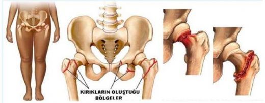 Kalça Kemiği Ameliyatı Riskleri ve Sonrası