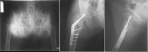 Kalça Kemiği Çatlağı Belirtileri ve Tedavisi