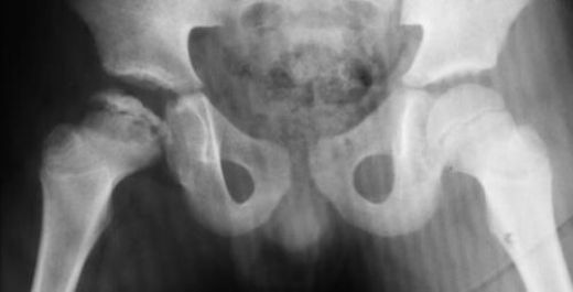Kalça Kemiği Çürümesi Belirtileri ve Tedavisi