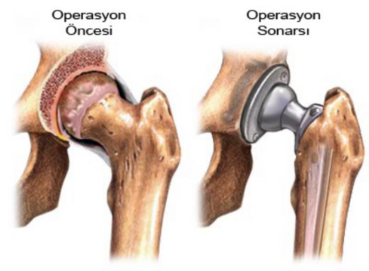 Kalça Kemiği Kireçlenmesi Belirtileri ve Tedavisi