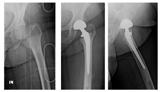 Kalça Kemiği Kırığı Ameliyatı Riskleri ve Sonrası