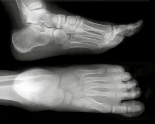 Kemik Çatlaması Belirtileri ve Tedavisi