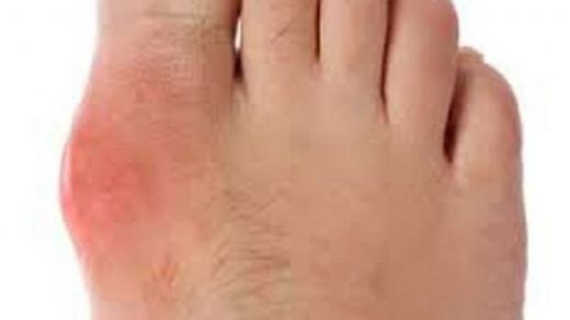 Kemik Çıkıntısı Sebepleri 