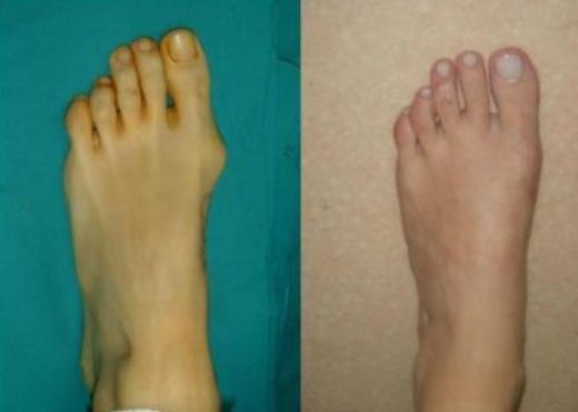 Kemik Çıkıntısı Ameliyatı Riskleri ve Sonrası