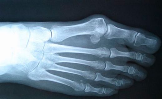 Kemik Hastalıkları Belirtileri ve Tedavisi