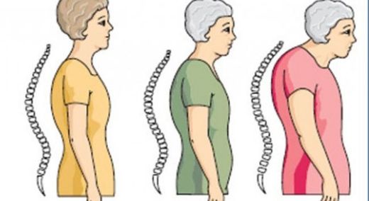 Kemik İncelmesi Belirtileri ve Tedavisi