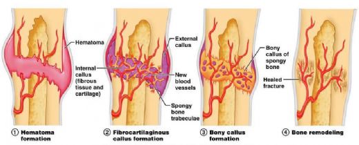 Kemik Kaynamasını Etkileyen Faktörler