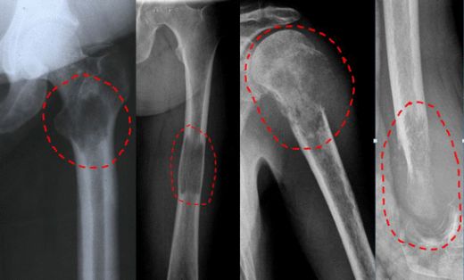 Kemik Kisti Belirtileri ve Tedavisi