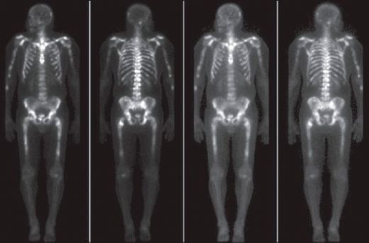 Kemik Metastazı Belirtileri ve Tedavisi