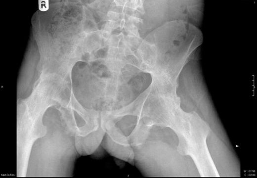 Kemik Ödemi Belirtileri ve Tedavisi