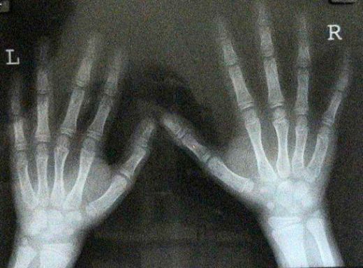 Kemik Yaşı Hesaplama