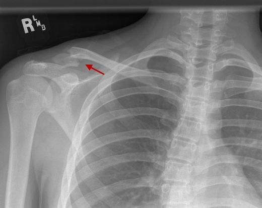 Köprücük Kemiği Kırılması Belirtileri ve Tedavisi