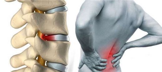Kuyruk Kemiği Ağrısı Belirtileri ve Tedavisi