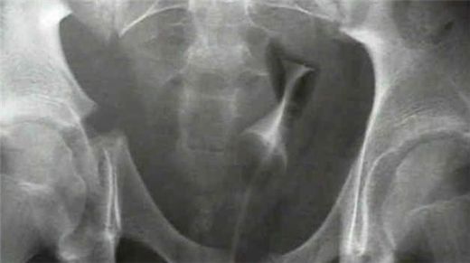 Leğen Kemiği Kırığı Belirtileri ve Tedavisi